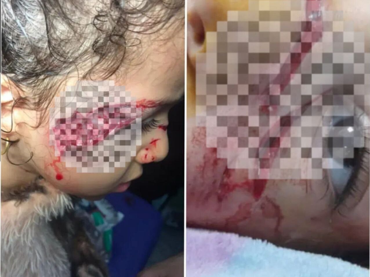تصاویر دلخراش از حمله سگ‌های ولگرد ‌به دختر ۵ ساله